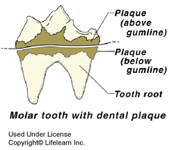 dental_disease1